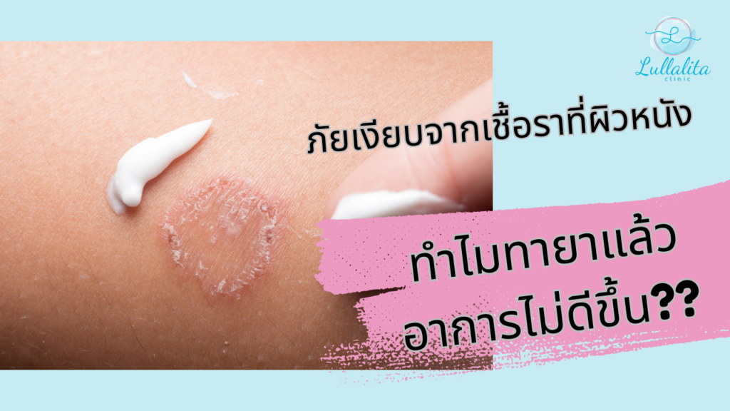 ระวัง! "กลากดื้อยา" ภัยเงียบจากเชื้อราที่ผิวหนัง ทำไมทายาแล้วอาการไม่ดีขึ้น?