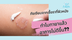 ระวัง! "กลากดื้อยา" ภัยเงียบจากเชื้อราที่ผิวหนัง ทำไมทายาแล้วอาการไม่ดีขึ้น?