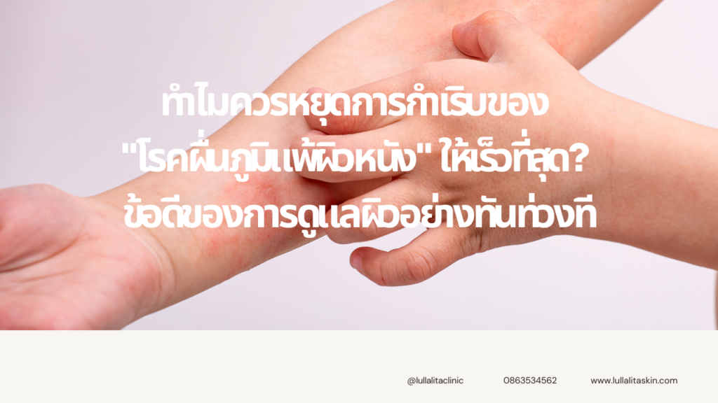 โรคผื่นภูมิแพ้ผิวหนัง