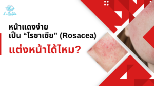 Rosacea