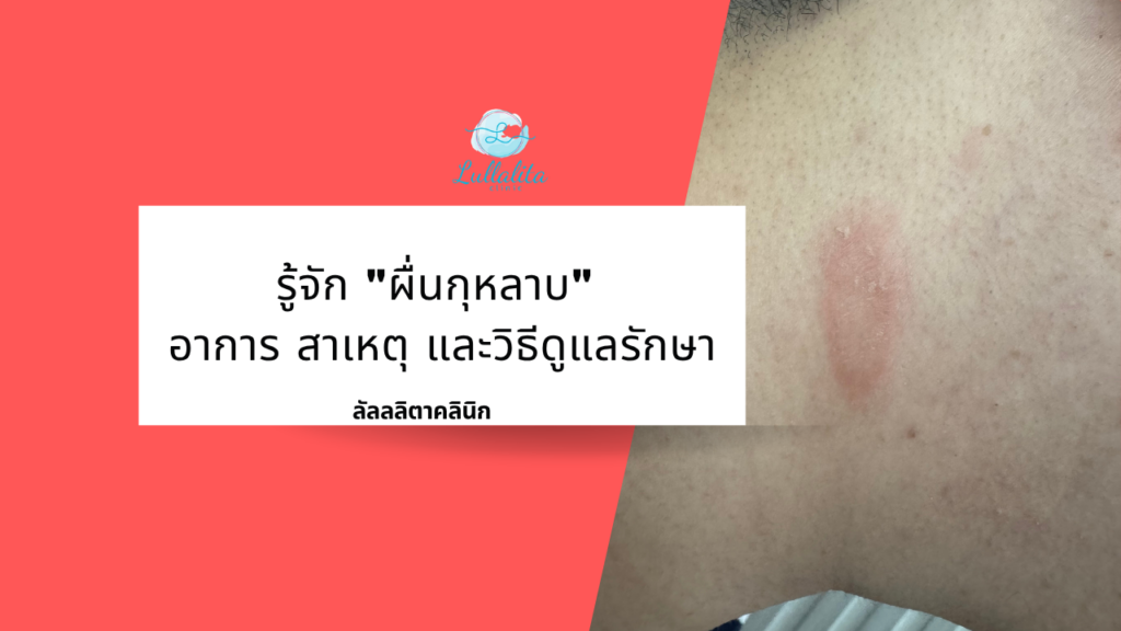 ผื่นกุหลาบ