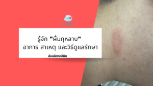 ผื่นกุหลาบ