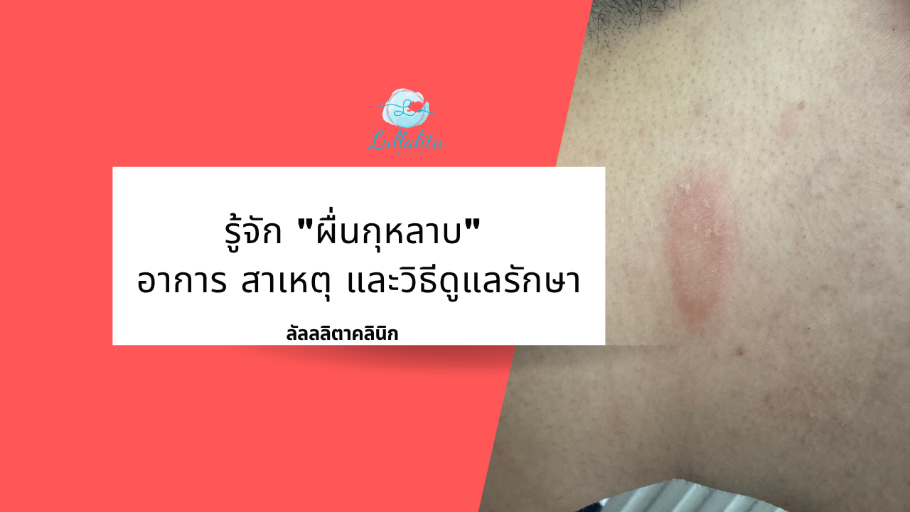 ผื่นกุหลาบ
