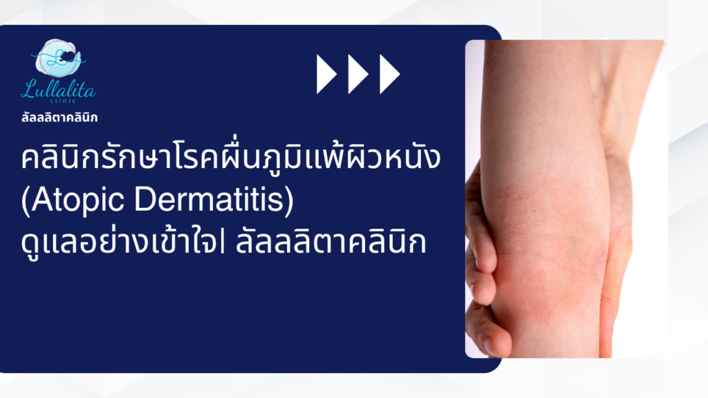 Atopic dermatitis