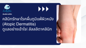 Atopic dermatitis