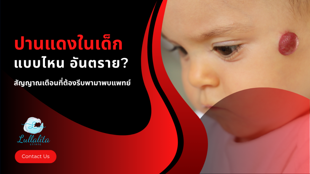 ปานแดงในเด็ก