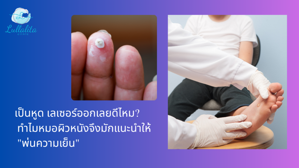 หูด ตาปลา