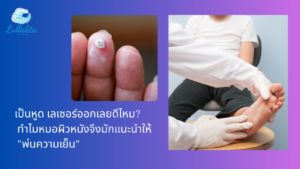 หูด ตาปลา