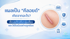 Keloid