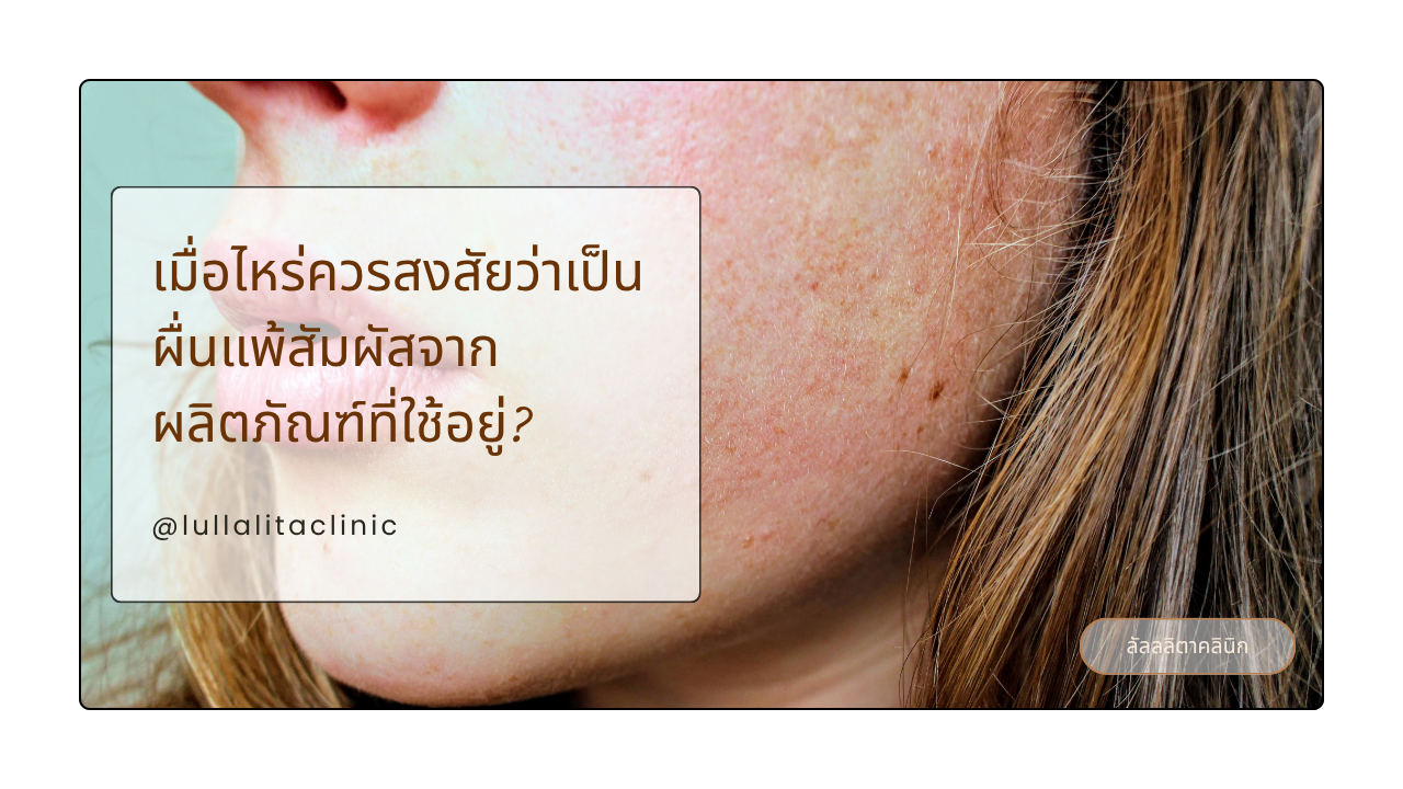 ผื่นแพ้สัมผัส