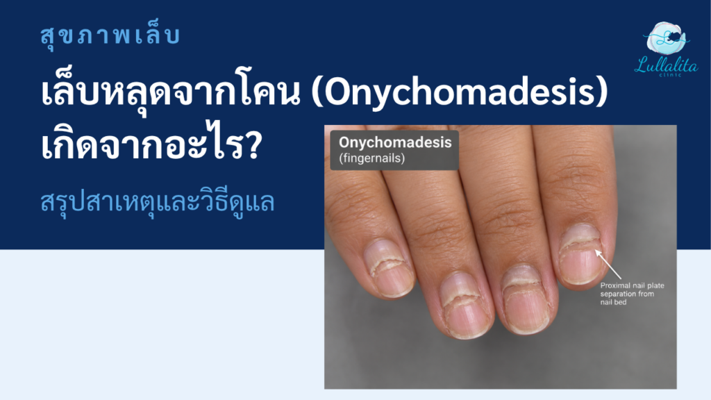 Onychomadesis เล็บหลุดจากโคน